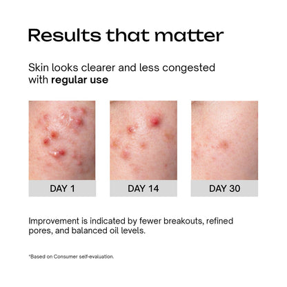 Salicylic Acid 2% Betaine 3% Serum